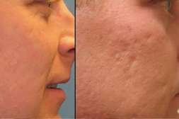 Bioaqua Anti Acne устраняет любые дефекты.